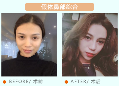 艾米丽潘红伟假体隆鼻好的地方